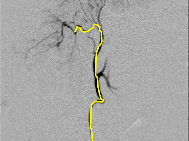 腹腔動脈選択～腹腔動脈造影