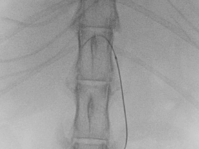 総肝動脈選択～feeder選択