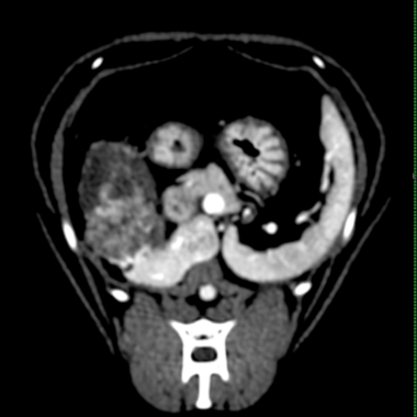 外科手術時（TAE後66日目）